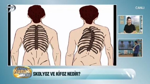 Skolyoz Ve Kifoz (Omurga Eğriliği) Nedir?