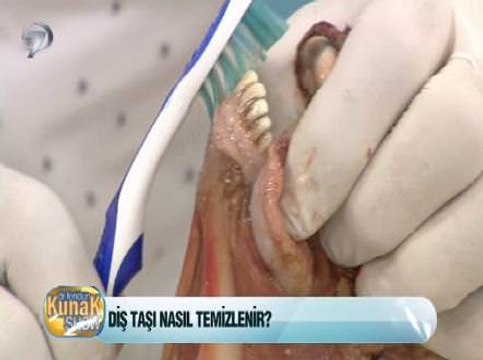 Diş Taşı Nasıl Temizlenir?