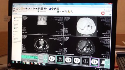 Sigara Koronaya Yakalanma Riskini 14 Kat Daha Arttırıyor