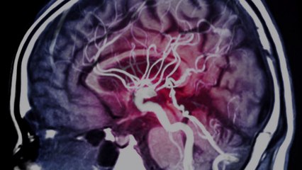 Tải video: COVID-19 Is Causing Blood Clots and Strokes in Some Patients—but Doctors Don't Know Why