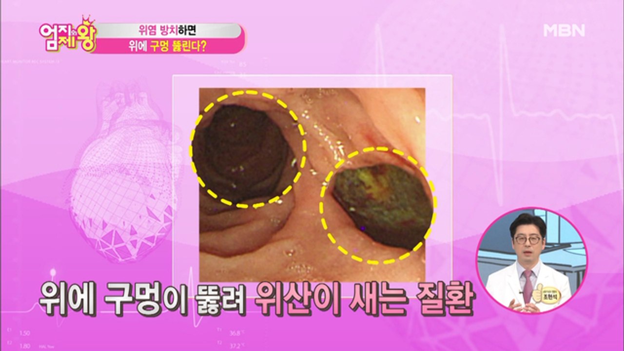 [서재걸의 인체교실]위염 방치하면 위에 구멍이 뚫린다?!