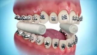 How are braces put on /Comment les accolades sont-elles mises