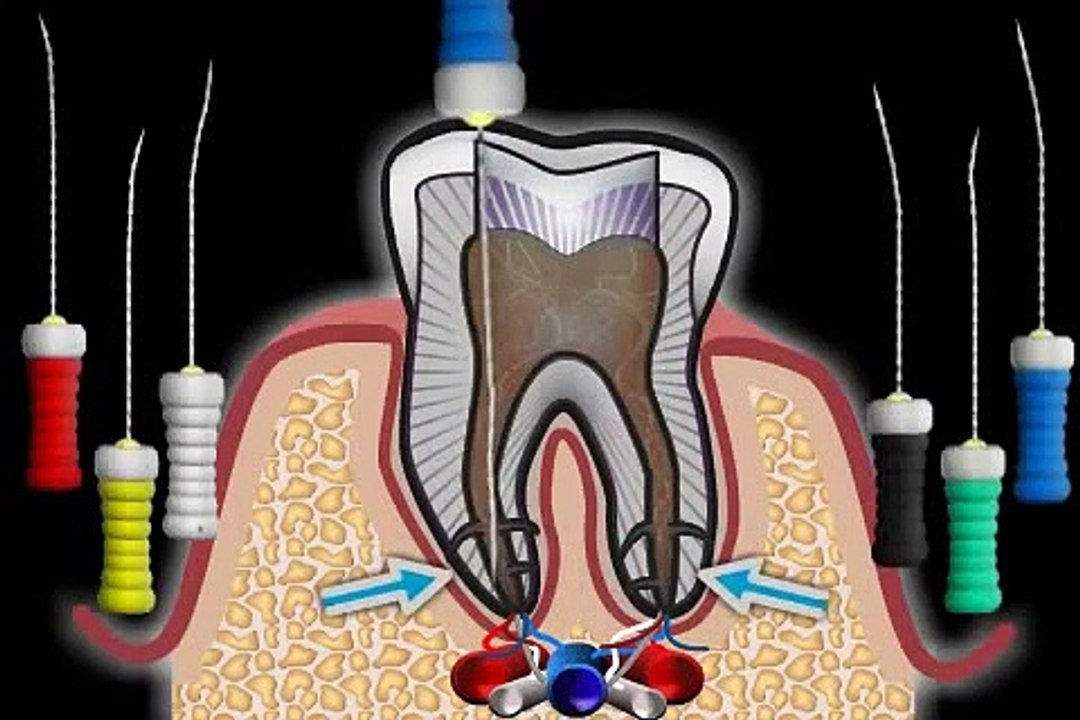 wieso wird ein Zahn wurzelbehandelt