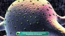 Implante cerebral restaura movimento de paciente com paralisia