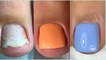 Most Amazing Ugly Toenails TransformationsGel Toenail Pedicure-Toenails Cleaning -3-BeautyPlus