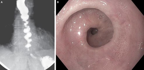 What Is Corkscrew Esophagus? Here’s What a Gastroenterologist Says