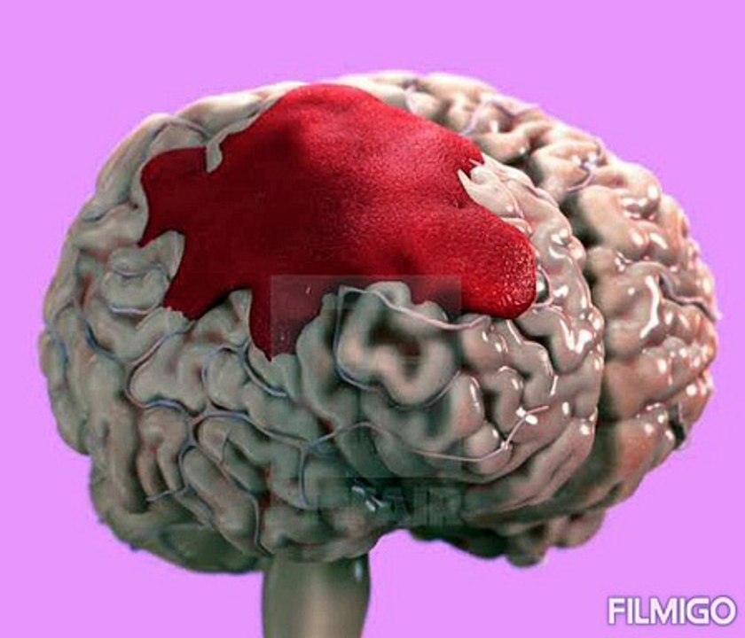Haemorrhage