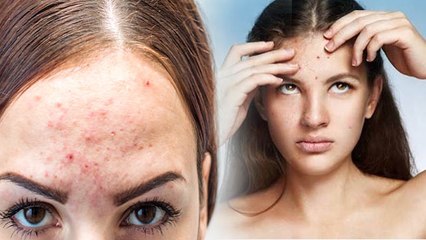 Forehead पर Pimples आने से रोकने के लिए ये हैं आसान घरेलु उपाय | Pimples On Forehead | Boldsky