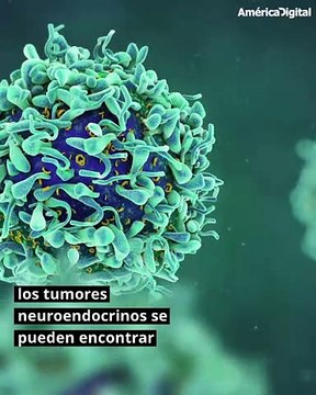 ¿Qué es el cáncer neuroendocrino? Lo que debes saber sobre la enfermedad que padecía el actor Irrfan Khan