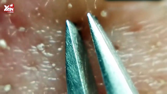 Mở mang tầm mắt với video cận cảnh từng sợi bã nhờn được lấy ra khỏi da mặt