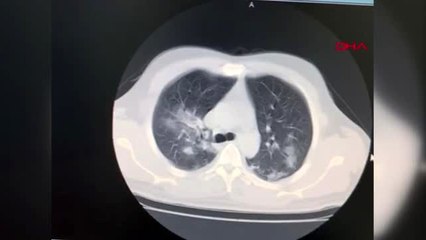 İSTANBUL Koronavirüsü yenen doktor anlattı Bilinç kaybı yaşadım, akciğerimin yüzde 70'ini virüs...