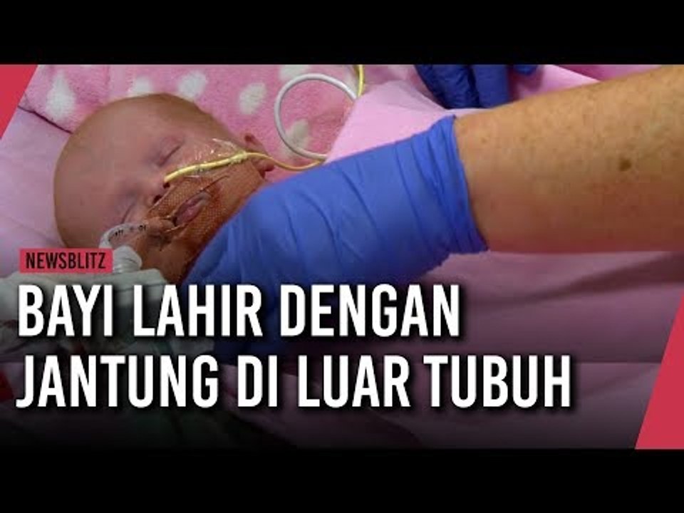 Bayi Lahir dengan Jantung di Luar Tubuh