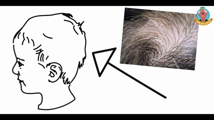 ! يا ترى ليه التخلص من القمل من سابع المستحيلات