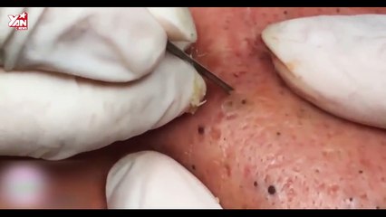 [Phê lòi #9 - 8.9.2018] Một ca mụn đầu đen nặng