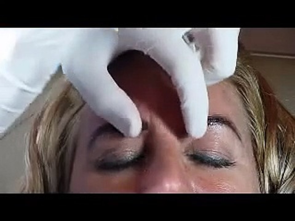Glabellar Botox Injection Technique Botox Class