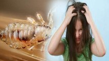 रातोंरात पाएं सिर की जुओं से छुटकारा, बस कर लें ये 4 काम | Get rid of head lice overnight | Boldsky