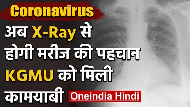 Coronavirus: सीने के एक्स-रे को देखकर हो सकेगी मरीज की पहचान KGMU को मिली कामयाबी | वनइंडिया हिंदी