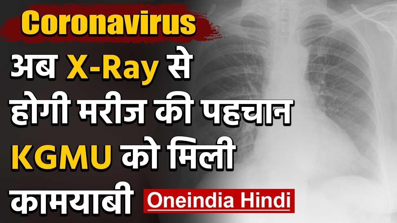 Coronavirus: सीने के एक्स-रे को देखकर हो सकेगी मरीज की पहचान  KGMU को मिली कामयाबी | वनइंडिया हिंदी