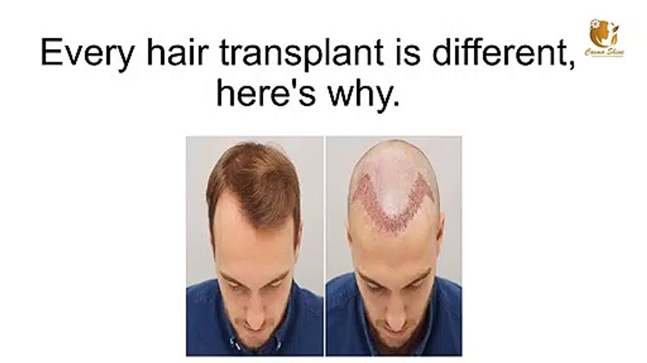 Every Hair Transplant Is Different, Here's Why