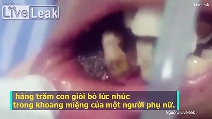 Nha sĩ chết ngất trước khoang miệng “tràn ngập” giòi của nữ bệnh nhân