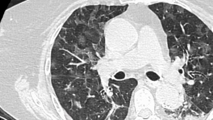 Santé - Poumons, quelles séquelles ?