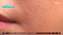 [스마트 리빙] '마스크 땀띠' 주의하세요