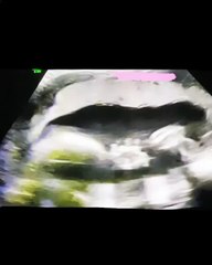 Δημοσίευσε υπερηχογράφημα με την αγέννητη κόρη της να κάνει άσεμνη χειρονομία