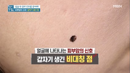 ※집중!※ 얼굴에 갑자기 생긴 '이것' 암의 신호다?