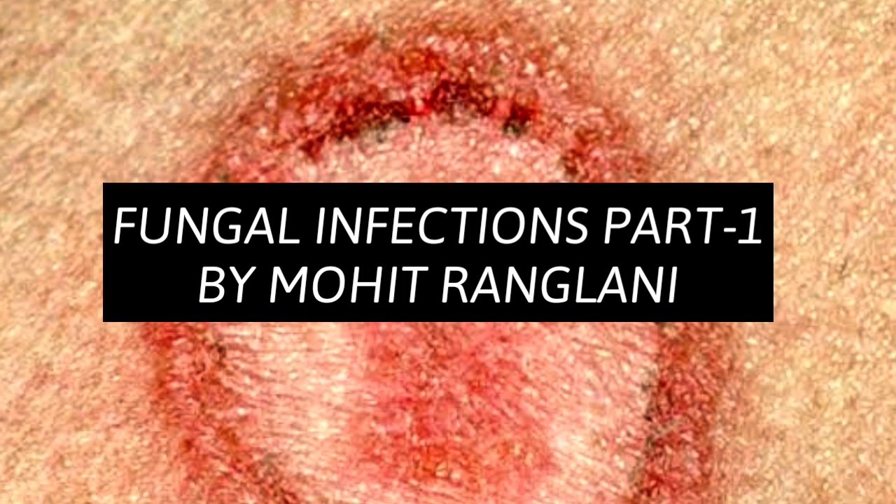 Types of fungal infection on skin | Fungal infection in hindi | Mohit Ranglani : The Pharmacist