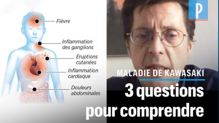 Syndrome de Kawasaki et Covid-19: "Une forte fièvre et des problèmes digestifs au premier plan"