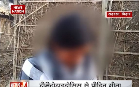 Patna: Girl with rare medical condition sheds tears of blood