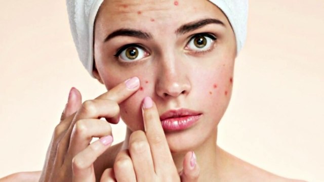 आपके चेहरे पर हुए एक्ने का मतलब क्या है, ये वीडियो देखें - How to avoid Pimples and Acne