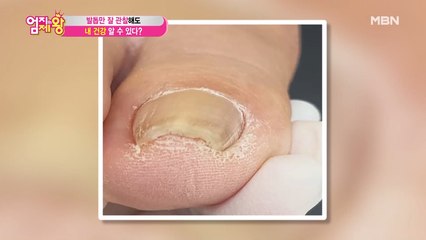 '발톱 모양이 자꾸 변해요…' 발톱만 잘 관찰해도 내 건강 알 수 있다!