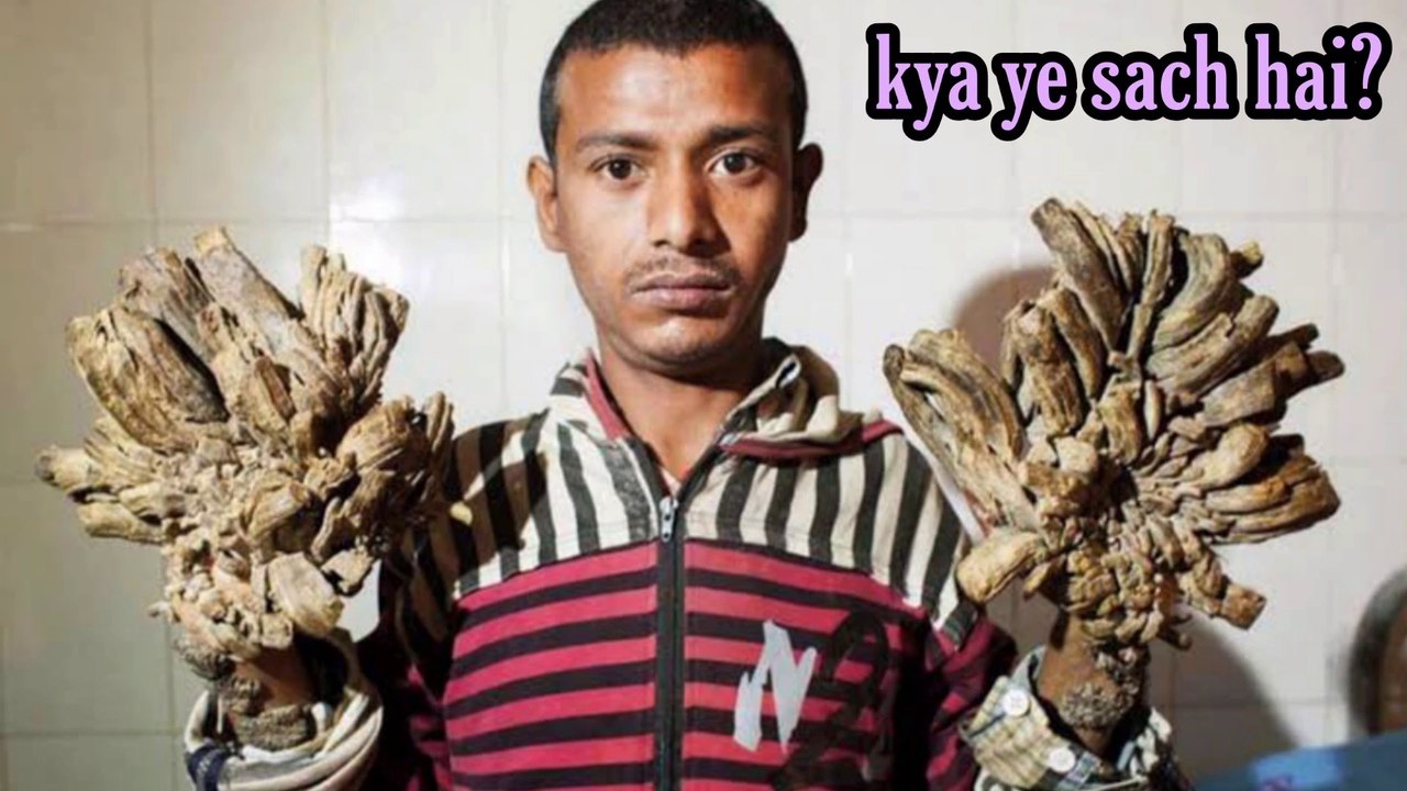 Is tree man a reality?? janiye Sach ( In hindi ) ||  Bizarre Medical condition part 2 || World Most weird and rare illness on our planet || Pharma Guru Medical information for very rare syndromes