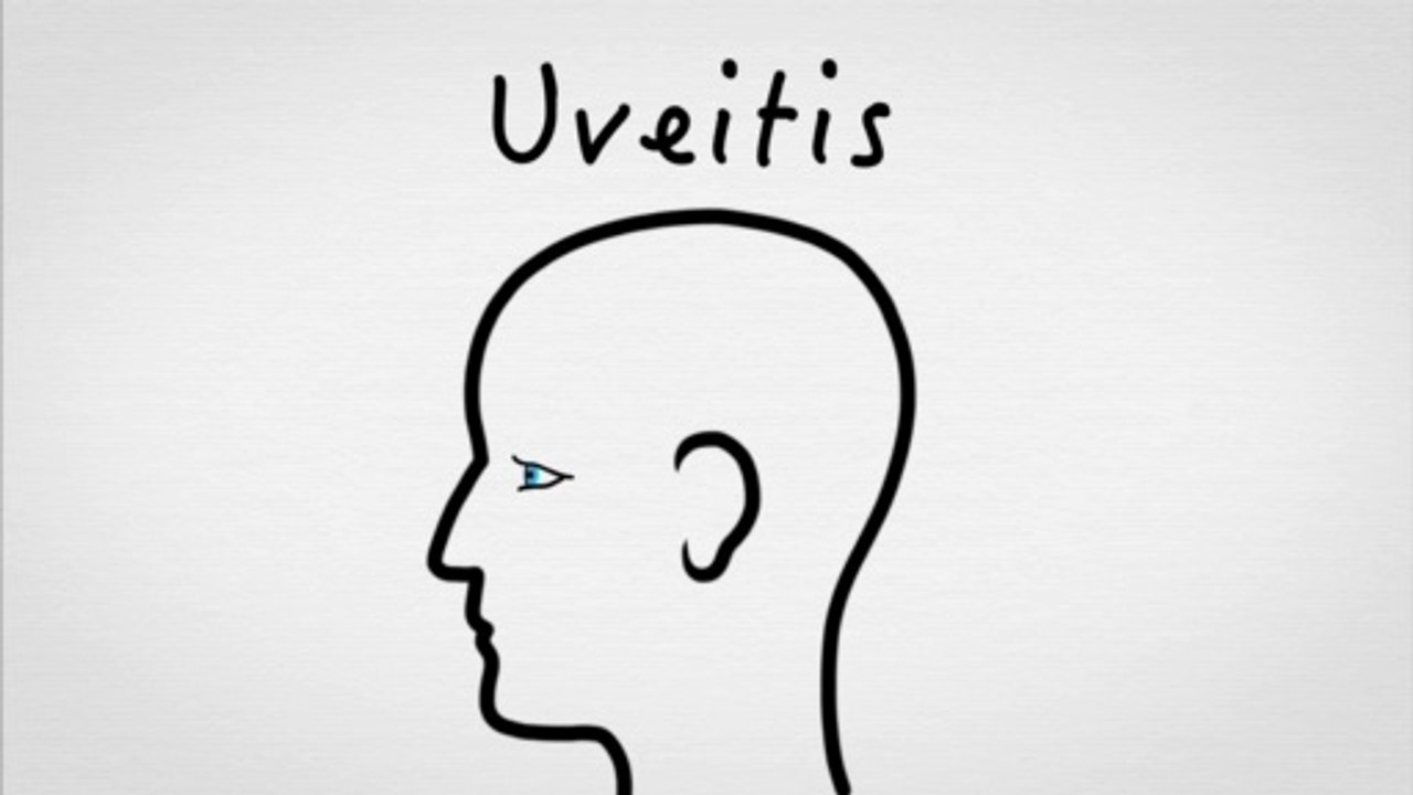 Uveitis : Educational video