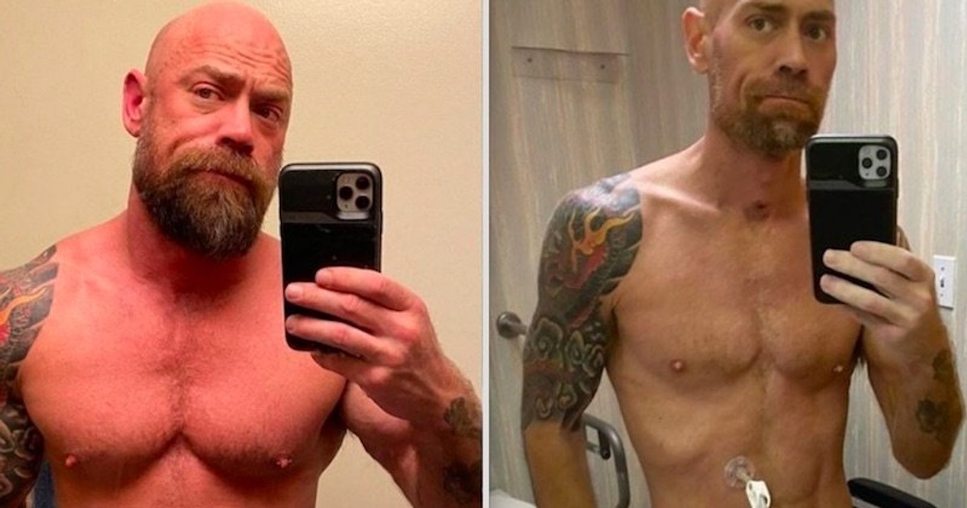 Contaminé, cet infirmier américain a publié une photo pour montrer les ravages du Covid-19 sur son corps meurtri