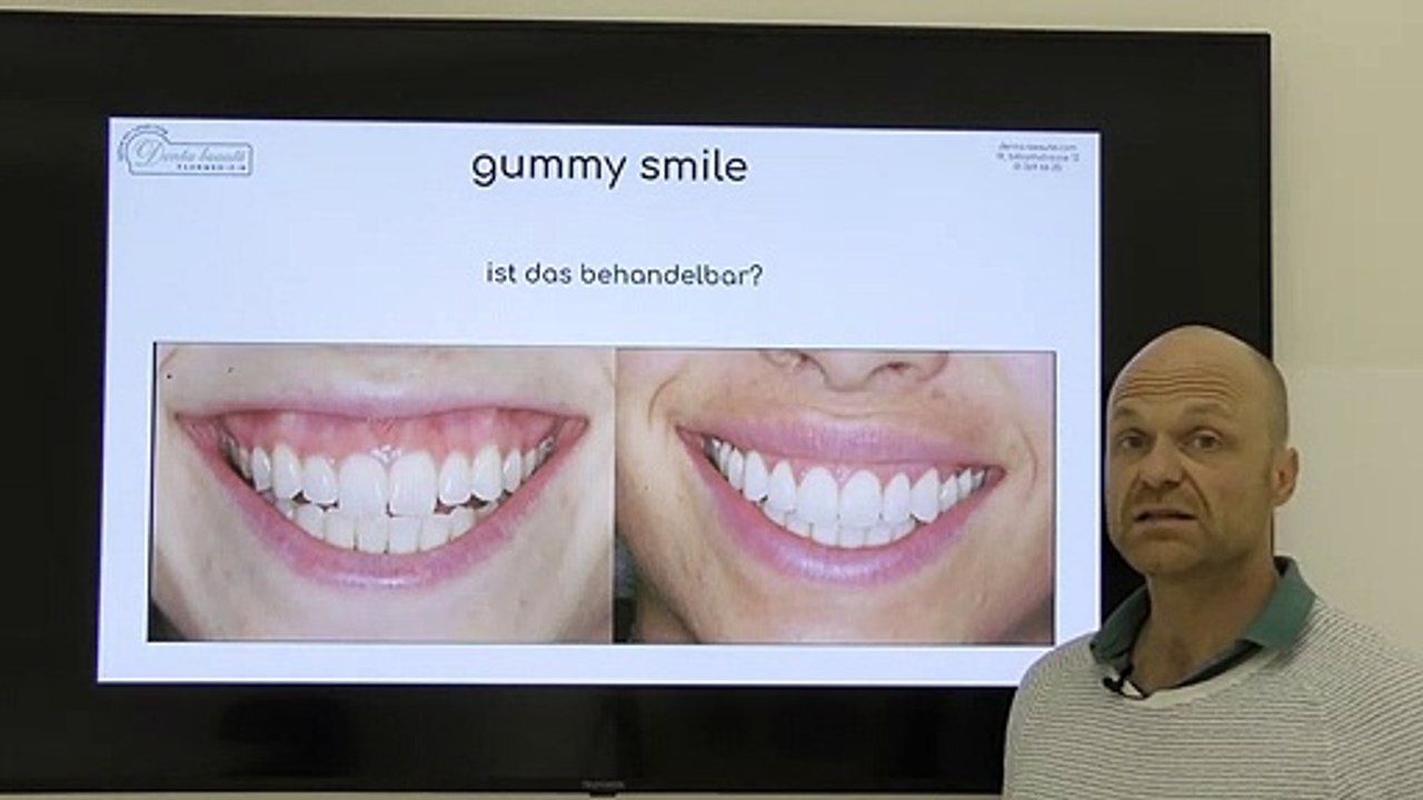 Gummy Smile - kann man das behandeln?