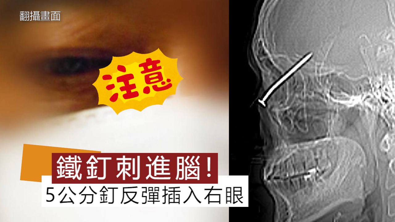 5公分鐵釘反彈 刺穿眼球插進腦