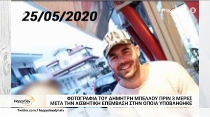 MasterChef: Οι πρώτες φωτογραφίες του Δημήτρη Μπέλλου μετά την αισθητική επέμβαση!