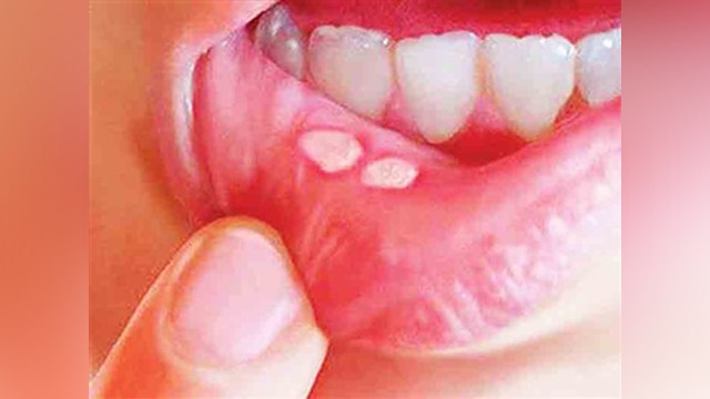 जीभ के छाले कर रहे हैं परेशान तो घरेलू नुस्‍खों से करें इलाज । home remedy for mouth ulcer । Boldsky