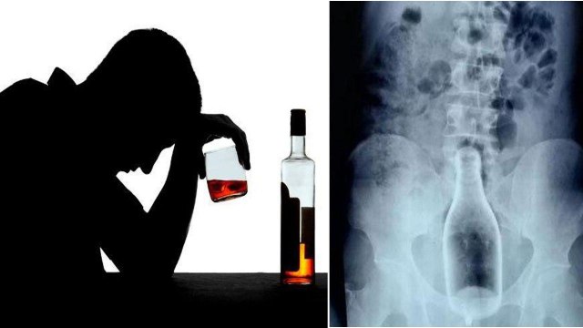 A Drunk Man Inserts Glass Bottle Into Body Through Anus