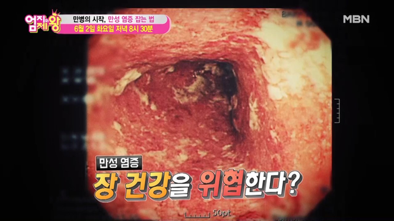 엄지의 제왕 385회 [만병의 시작, 만성 염증 잡는 법]