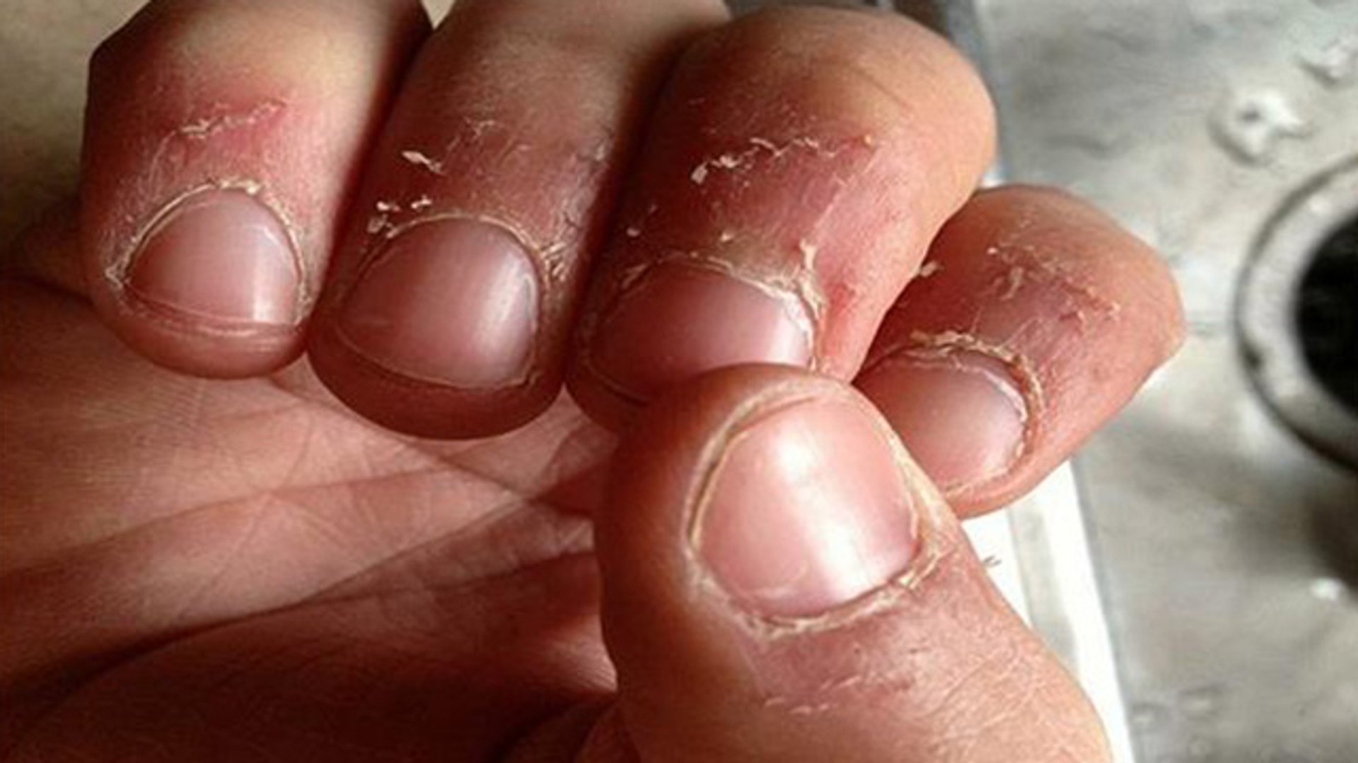 Nails के आसपास की Skin छिल जाती है, तो करें ये उपाय । Get rid of dry skin around nails । Boldsky - video Dailymotion