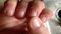 Nails के आसपास की Skin छिल जाती है, तो करें ये उपाय । Get rid of dry skin around nails । Boldsky