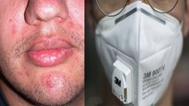 Mask पहनने से हो रही है Pimples और Acne की Problem तो करें ये उपाय | Boldsky