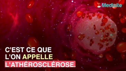 Athérosclérose : quels risques pour la santé ?