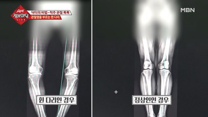 휜 다리가 퇴행성 관절염을 앞당긴다?