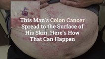 This Man’s Colon Cancer Spread to the Surface of His Skin. Here’s How That Can Happen