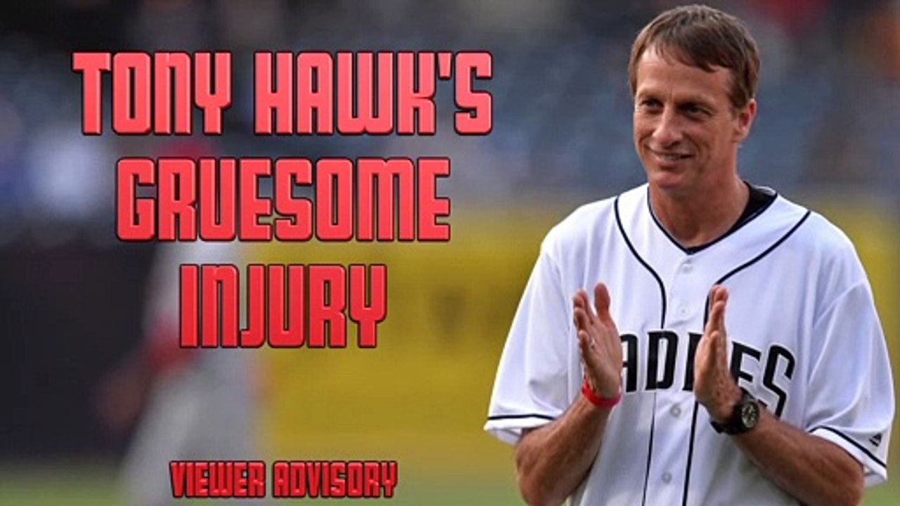 Tony Hawk Suffers Gruesome Hand Injury While Skateboarding