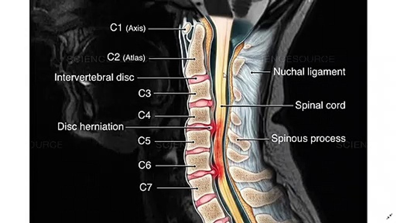 Cervical spondylosis, dizziness, C1-C7, neck pain, Headache & Migraines